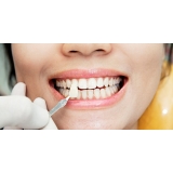 quanto custa lente para dentes Jardim Duprat