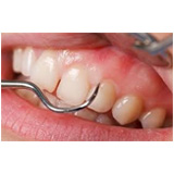 Tratamento de Periodontia