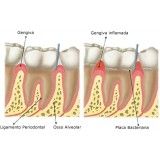 tratamento de periodontia quanto custa no Jardim Bom Refúgio