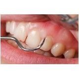 tratamento de periodontia no Capelinha