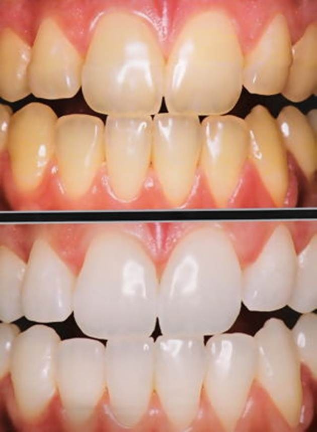 Tratamento com Aparelhos Estéticos na Vila Indiana - Clínica para Tratamentos Dentários