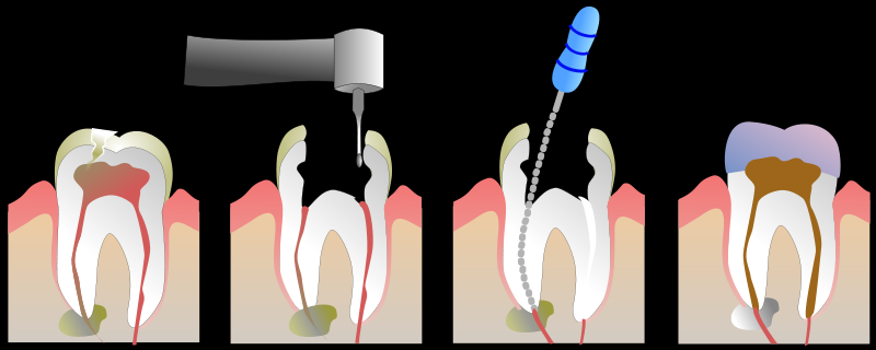 Tratamento Dentário com Resina Embu das Artes - Clínica de Tratamento Dentário