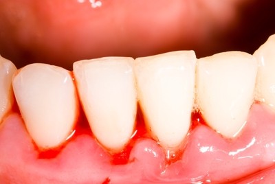 Tratamento para Periodontite Preço no Jardim Jobar - Dentista Especialista em Periodontia